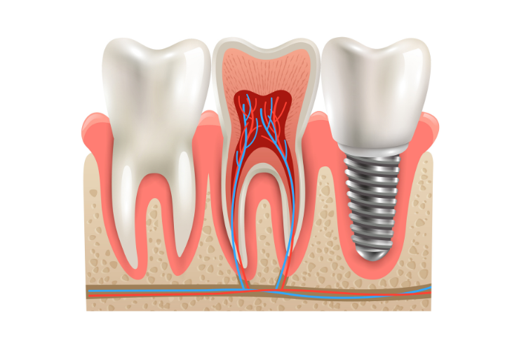 Dental Implants