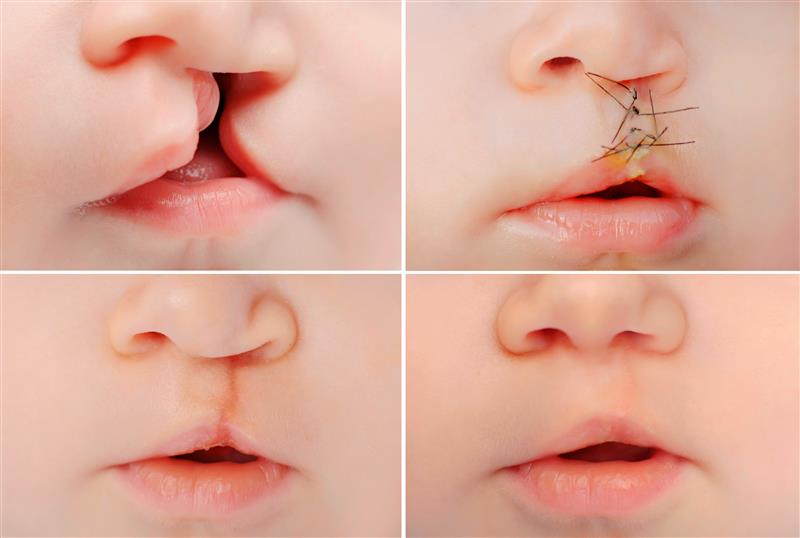 cleft surgery