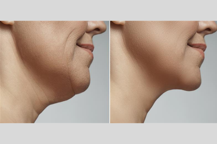 Facial Cosmetic surgery