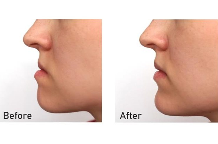 Orthognathic Surgery